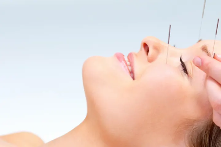 Fine acupuncture needles placed on a woman’s face